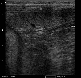 Ecografía de Cuello